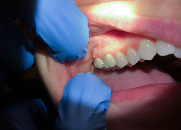 Best Emergency Dentist for Lost Fillings or Crowns in Watsessing, NJ